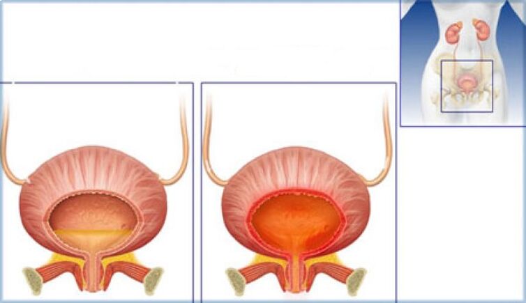 The bladder is normal and shows signs of inflammation due to cystitis